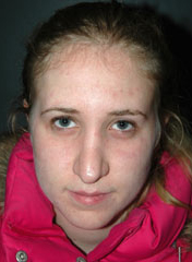 Rhinoplasty before and after - before