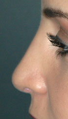 Rhinoplasty before and after - after
