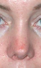 Rhinoplasty before and after - after