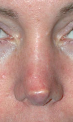 Rhinoplasty before and after - before