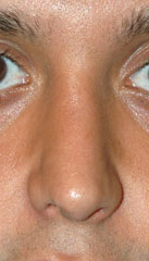 Rhinoplasty before and after - after