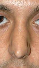 Rhinoplasty before and after - before