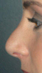 Rhinoplasty before and after - before
