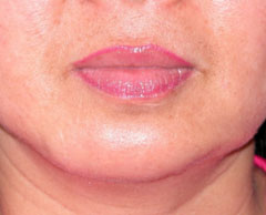 Chin before and after - after