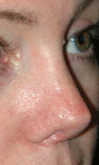 Rhinoplasty before and after - after