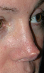 Rhinoplasty before and after - before