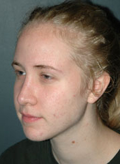 Rhinoplasty before and after - after