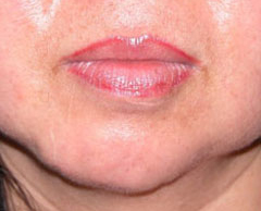 Chin before and after - before
