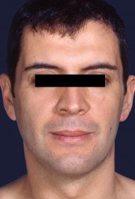 Liposuction before and after - after