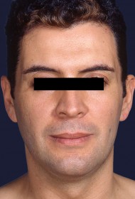 Liposuction before and after - before