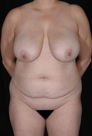 Breast Reduction before and after - before