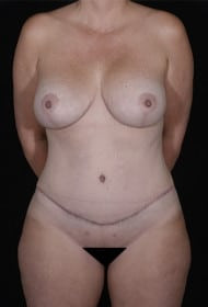 Mommy Makeover before and after - after