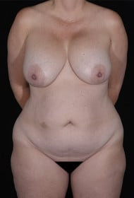 Mommy Makeover before and after - before