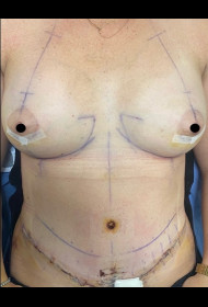 Mommy Makeover before and after - after