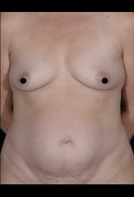 Mommy Makeover before and after - before
