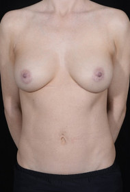 Breast Augmentation before and after - after