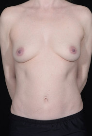 Breast Augmentation before and after - before