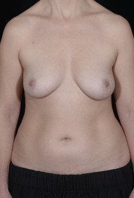 Breast Augmentation before and after - before