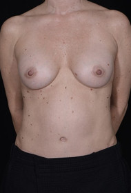 Breast Augmentation before and after - after