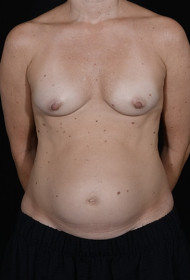 Breast Augmentation before and after - before