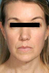 Liposuction before and after - after