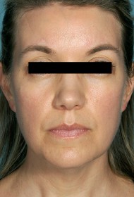 Liposuction before and after - before