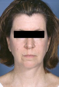 Liposuction before and after - after