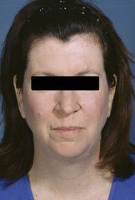 Liposuction before and after - before