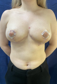 Breast Reduction before and after - after