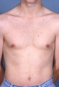 Breast Reduction before and after - after