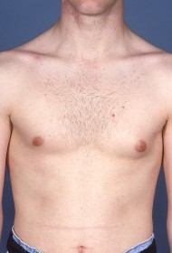 Breast Reduction before and after - before