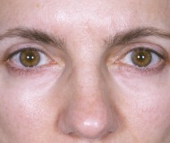 Procedure before and after - after