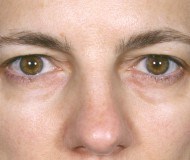Procedure before and after - before