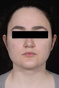 Procedure before and after - after