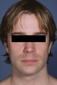 Liposuction before and after - after