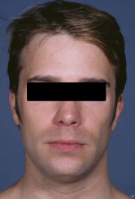 Liposuction before and after - before