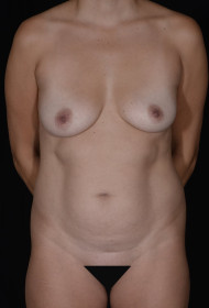 Mommy Makeover before and after - before
