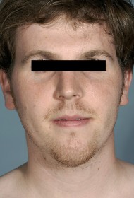 Liposuction before and after - after