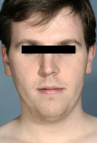 Liposuction before and after - before