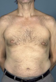 Breast Reduction before and after - after