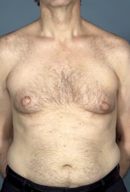 Breast Reduction before and after - before