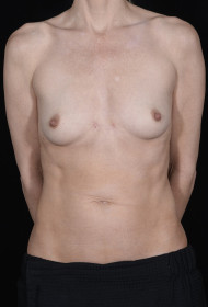 Breast Augmentation before and after - before
