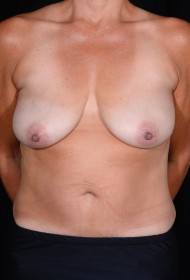 Procedure before and after - before