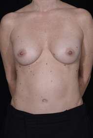 Mommy Makeover before and after - after