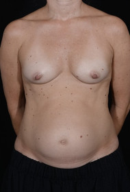 Mommy Makeover before and after - before