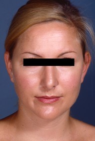 Liposuction before and after - after