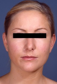 Liposuction before and after - before