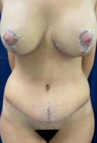 Procedure before and after - after