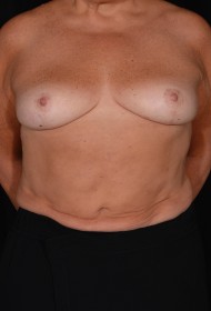 Breast Reduction before and after - after