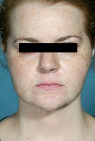 Liposuction before and after - after